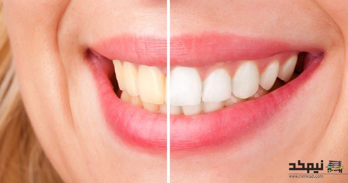 تا عید دندان هایتان را سفیدتر کنید !