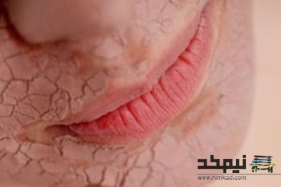 ﻿ ۶ علامت کمبود آب بدن